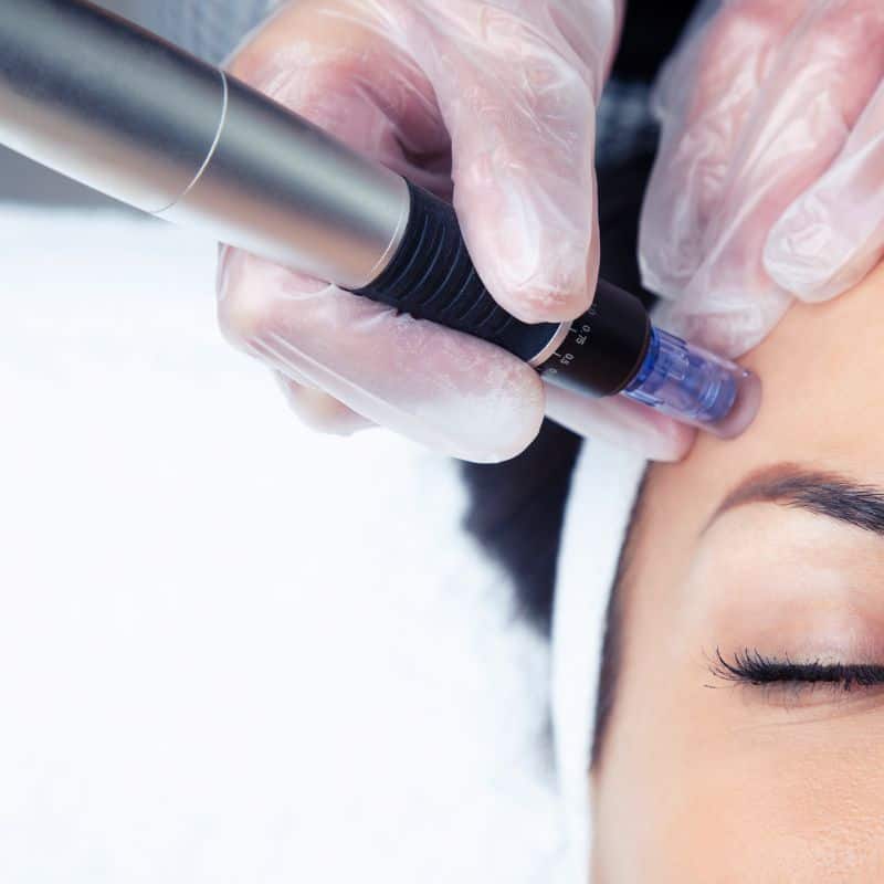 Morpheus8 treatment Blandford Camp from Lipo Sculpt - Book in today!